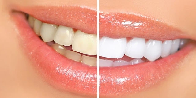 3 Easy And Cheap Tips To Keep Your Teeth White Naturally