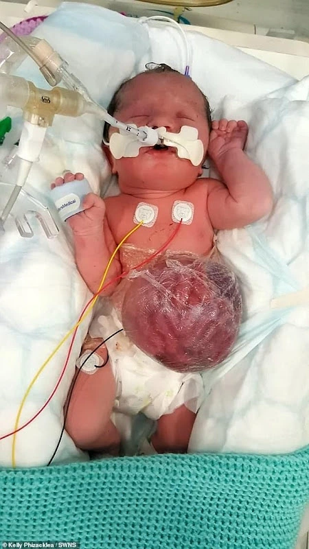 Doctors Told Her Parents That She Would Not Be Born Alive And She Turns 2 With Her Organs out
