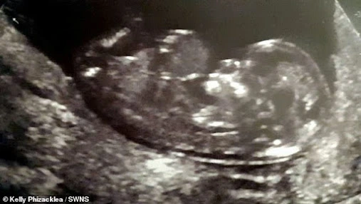 An ultrasound of Laurel in the womb showed that her organs were growing out of her body - a condition known as exomphalos
