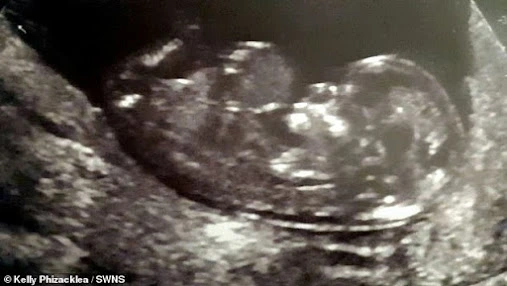 An ultrasound of Laurel in the womb showed that her organs were growing out of her body - a condition known as exomphalos