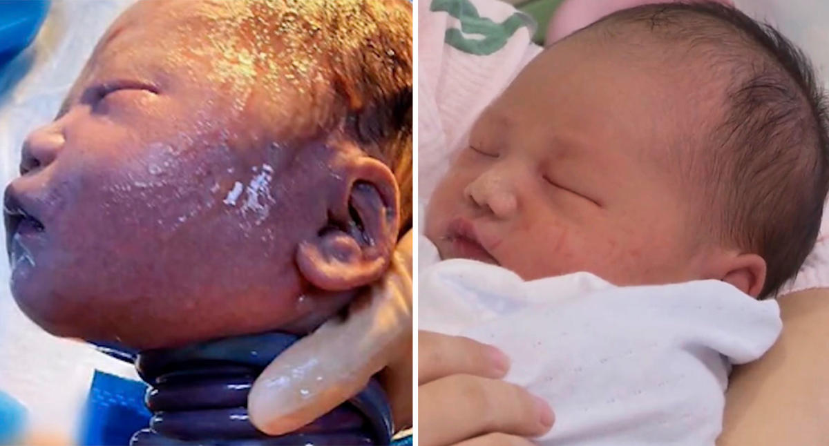 A Baby’s Umbilical Cord Was Wrapped 6 times Around His Neck And They Delivered Naturally