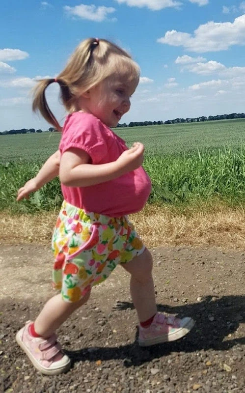 Doctors Told Her Parents That She Would Not Be Born Alive And She Turns 2 With Her Organs out