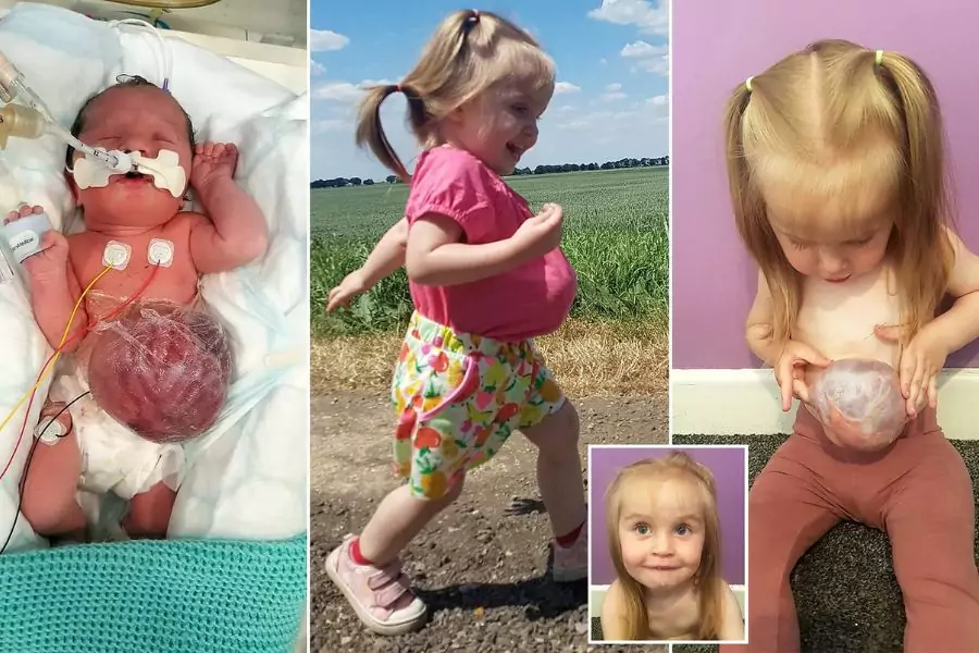 Doctors Told Her Parents That She Would Not Be Born Alive And She Turns 2 With Her Organs Out