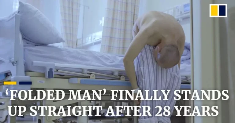 Folded Man’ Stands Tall After 28 Years Following Life-Changing Surgery for Rare Disease