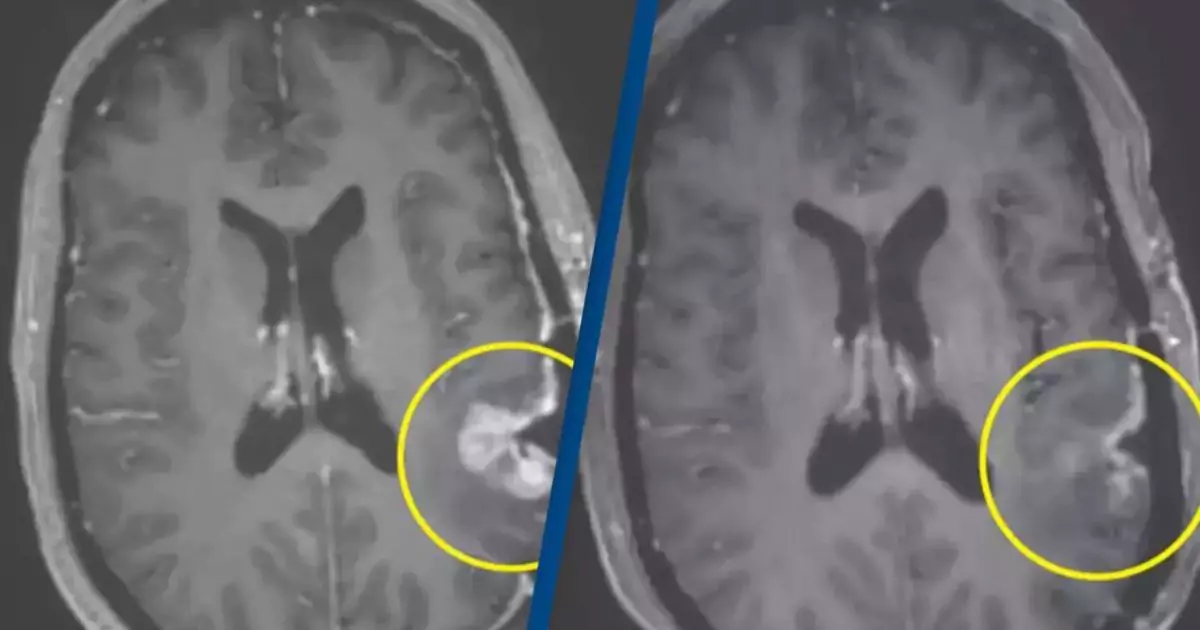 Remarkable Cancer Breakthrough Shows Woman’s Brain Tumor Nearly Vanishes in Just Five Days