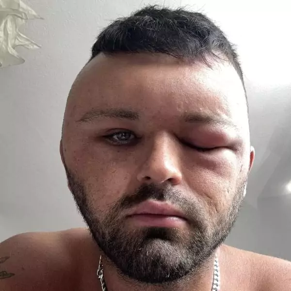 Man's Severe Allergic Reaction to Hair Dye Leaves Him Unrecognizable—Even His Girlfriend Couldn’t Look at Him