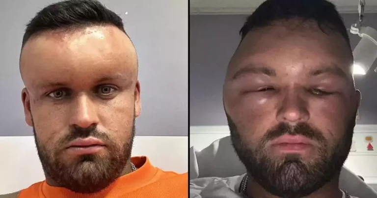 Man’s Severe Allergic Reaction to Hair Dye Leaves Him Unrecognizable—Even His Girlfriend Couldn’t Look at Him