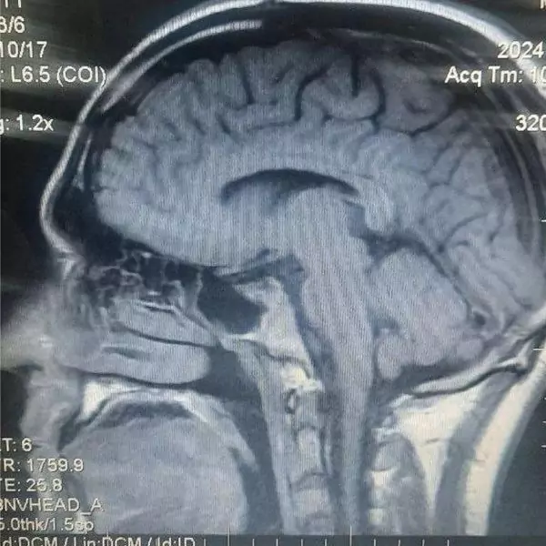 Man with brain fluid leaking, a rare case of cerebrospinal fluid leak through the nose.