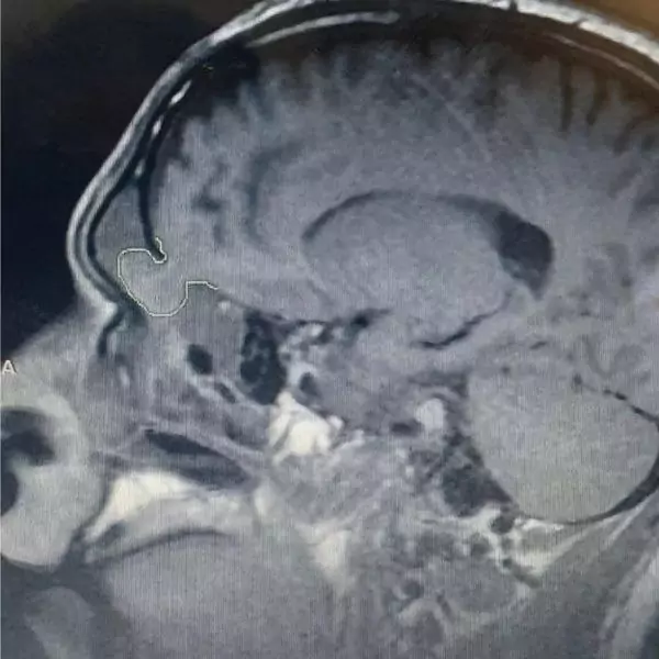 Man with brain fluid leaking, a rare case of cerebrospinal fluid leak through the nose.