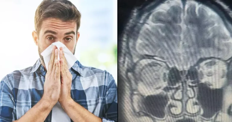 Man Discovers Persistent Runny Nose Was Actually a Brain Fluid Leak